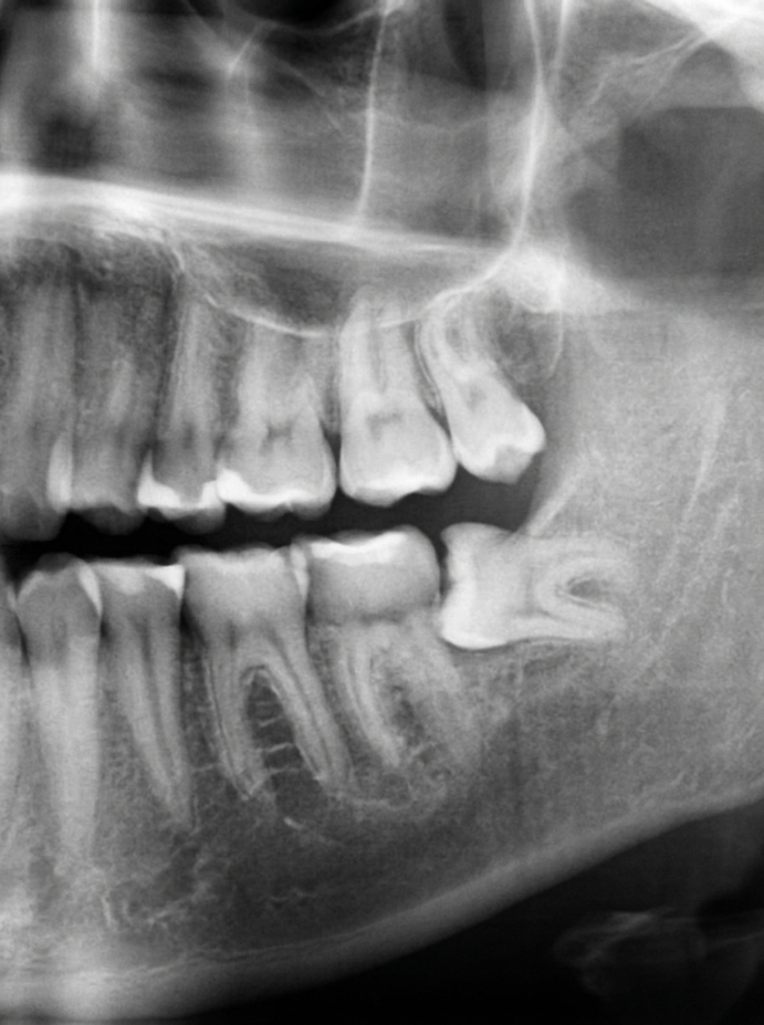 Surgical / Impacted Wisdom Tooth Extraction